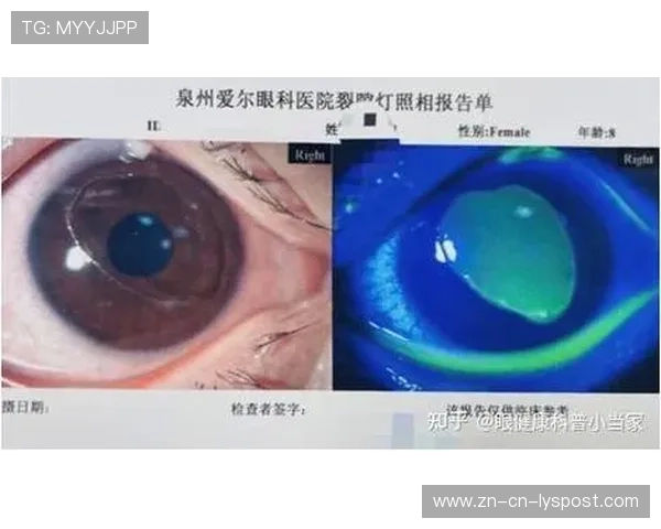 职业选手的“眼部健康”调查:长期专注屏幕对视网膜的损害有多大?
